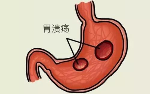 胃肠溃疡要怎样进行预防？